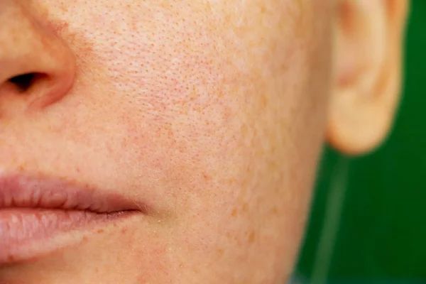 pores dilatés joues - nez - solution