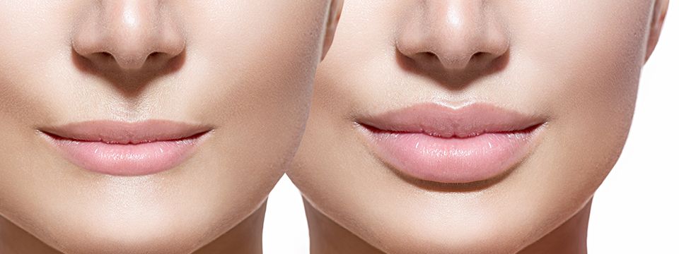 injection levre - acide hyaluronique