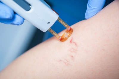laser-vasculaire.jpg