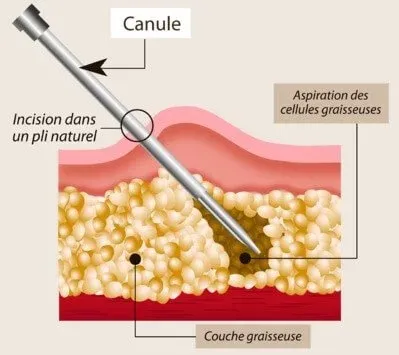 schéma liposuccion procédé