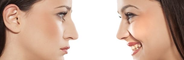 Rhinoplastie