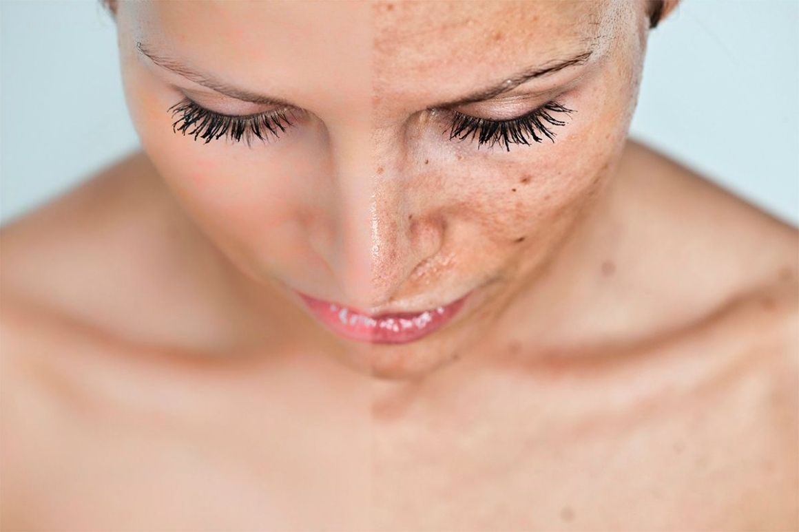 hyperpigmentation