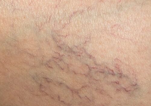 laser-vasculaire.jpg