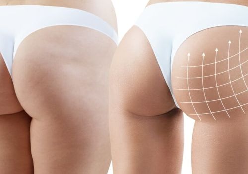 chirurgie-fessiers.jpg